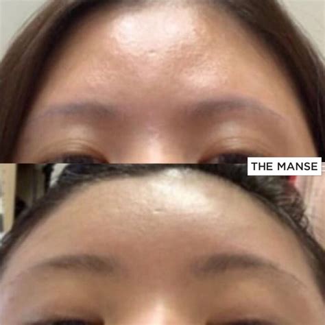 forehead filler case study  clinic sydney  dermal fillers