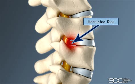 common herniated disc procedures spine orthopedic center