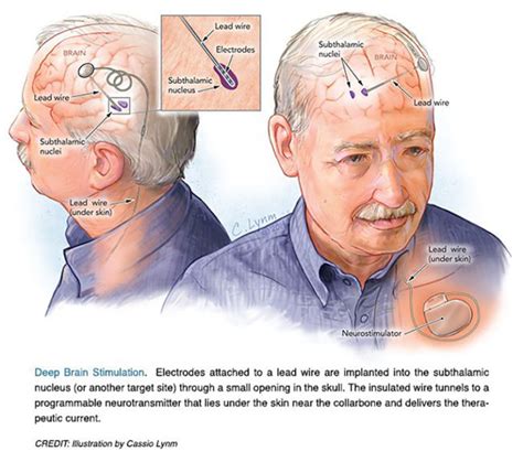 deep brain stimulation  parkinsons disease lasker foundation