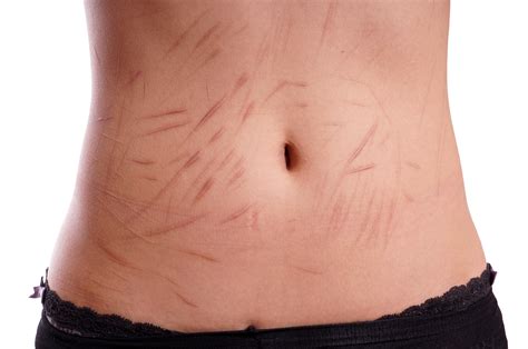 harm  scars   result amoilscom