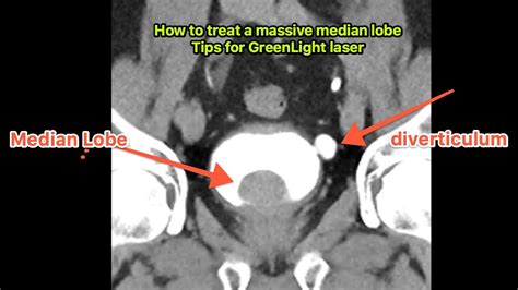 Tips For Managing A Large Prostate Median Lobe How To Greenlight Laser