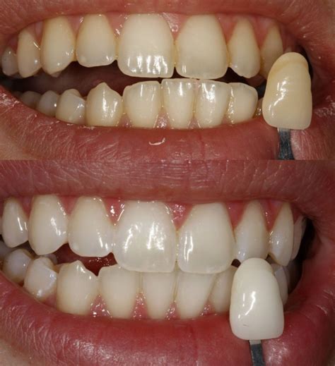 guide  teeth whitening