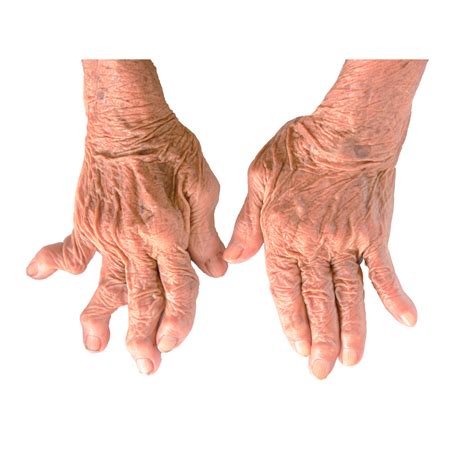 symptoms  rheumatoid arthritis net health book