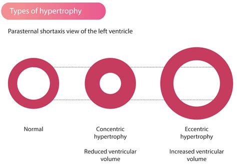 hypertrophic cardiomyopathy hcm hypertrophic obstructive