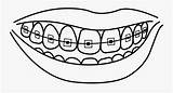 Braces Teeth Clipart Coloring Smile Pages Mouth Template Sketch Collection Cigar Drawing Tooth Transparent Dental Webstockreview Clipground Human Cartoon Pngitem sketch template