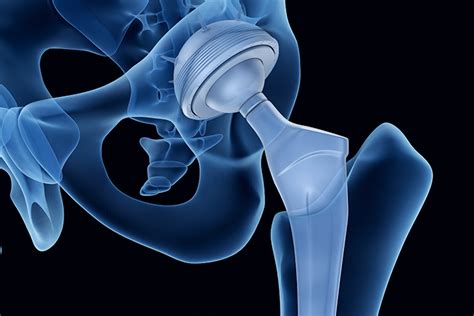 everything you need to know about direct anterior hip replacements