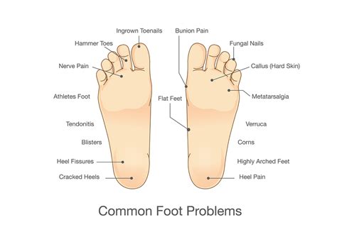 Common Foot Problems Werkman Boven And Associates