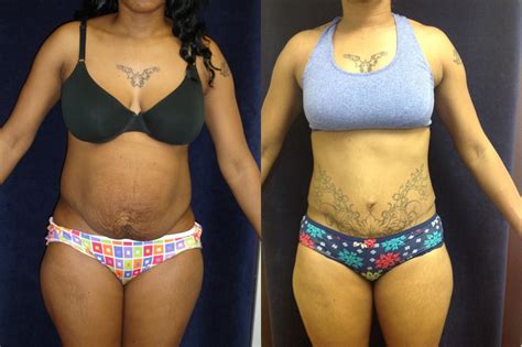 tummy tuck before and after photos patient 137 san francisco ca