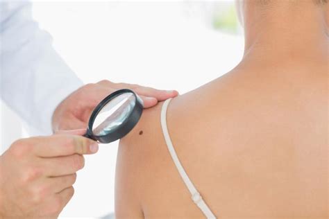 When Should You Worry About A Mole Ali Hendi Md Skin Cancer Specialists
