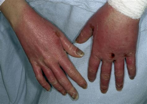 Severe Synergistic Toxicity From Docetaxel In A Patient