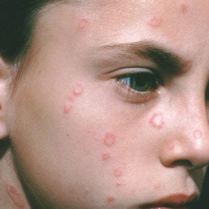 kids ringworm
