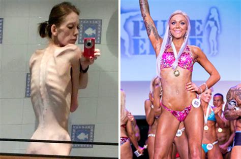 Anorexic Woman Gains 4st To Become Bodybuilder In Just 18 Months