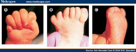 Recognizing The Clinical Features Of Trisomy 13 Syndrome