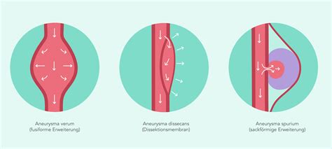 aneurysma ursachen symptome behandlung