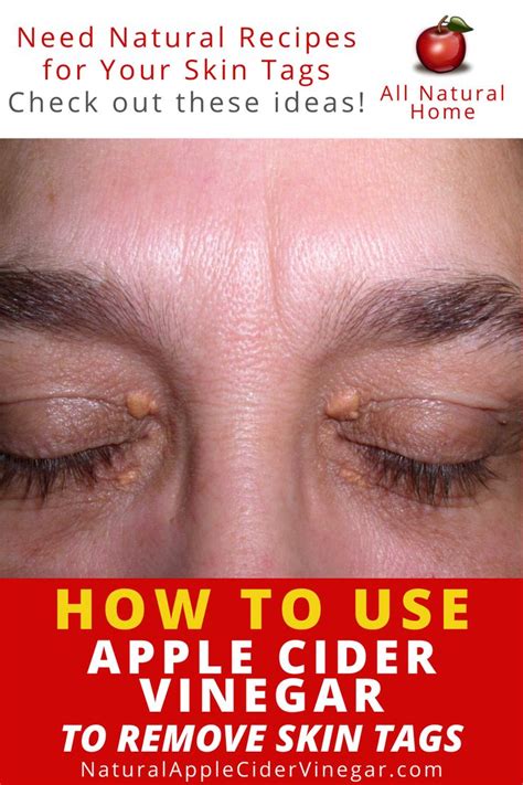 how to use apple cider vinegar to remove skin tags in 2020 apple