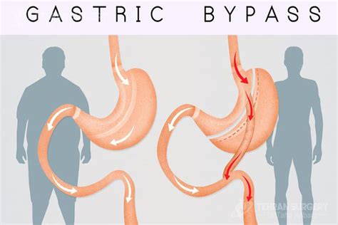 Gastric Bypass Risks And Complications Complications Of