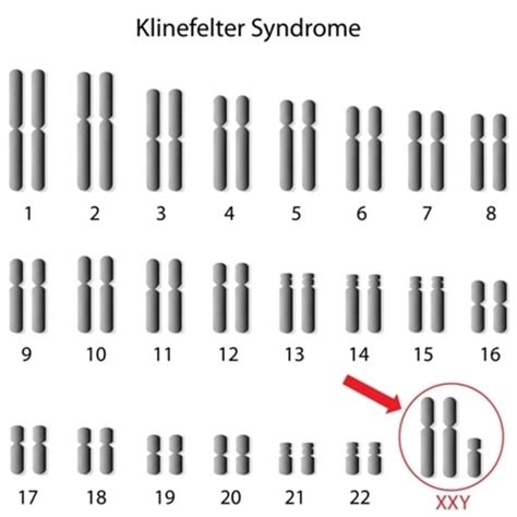 Hội Chứng Klinefelter Khoa Học Thường Thức