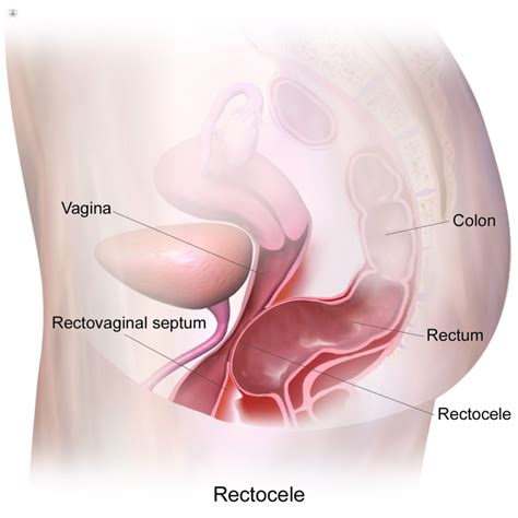 Rectocele What Is It Symptoms Causes Prevention And