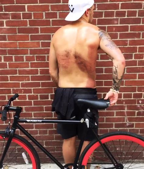 gus kenworthy hit by a car shows off horrific friction