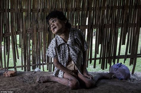 Indonesian Village S Mentally Ill Patients Are Pictured