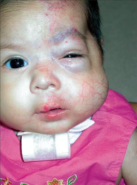 clinical spectrum and risk of phace syndrome in cutaneous and airway hemangiomas congenital