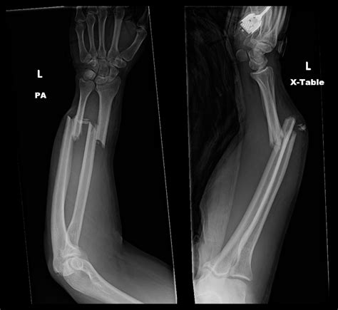radius ulna shaft both bone forearm orif