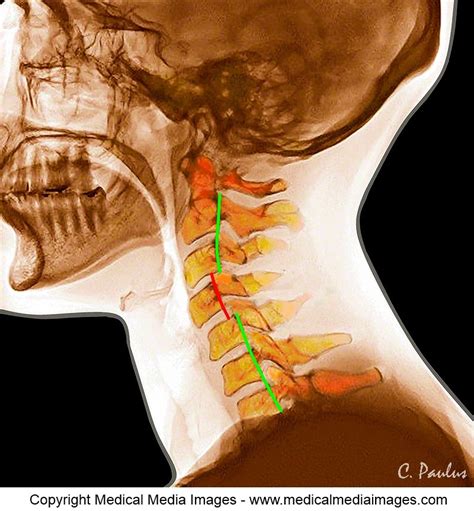 chiropractic color x ray showing a chiropractic cervical