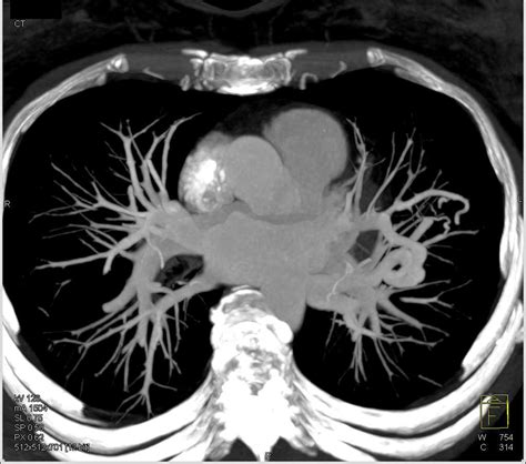 Cureus Pulmonary Arteriovenous Malformations A Rare Cause Of Hot Sex