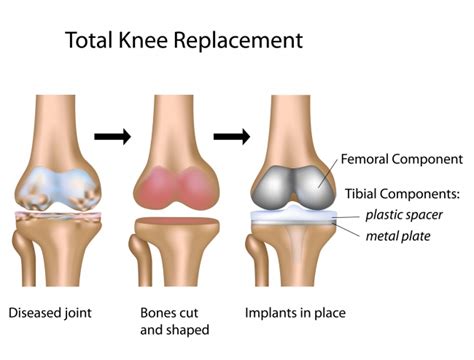 Total Knee Replacement Knee Replacement Surgery In Mexico