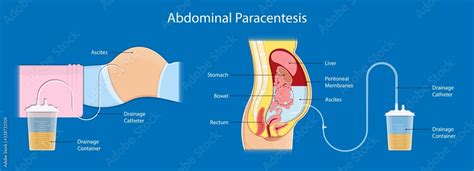 Ascites Paracentesis Medical Procedure Diagnostic Abdominal Bacteria