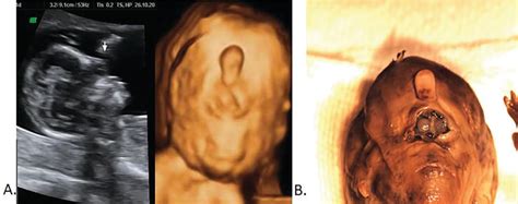 congenital abnormalities   fetal face intechopen