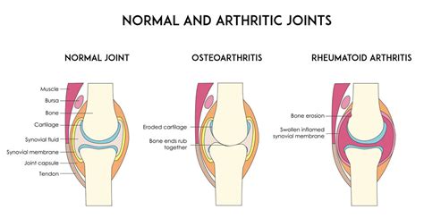 conditions treated arthritis melbourne hand therapy