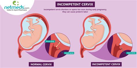 cervix before and during pregnancy