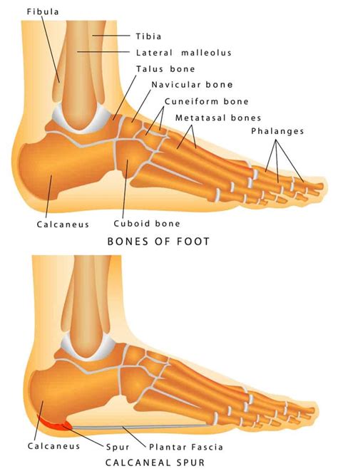 Bone Spur Treatment Symptoms And Prevention Preferred Foot And Ankle