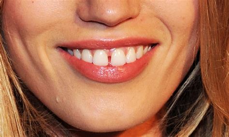 gap   teeth teethwalls