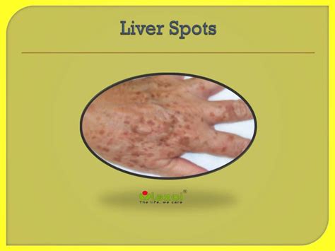 liver spots  symptoms daignosis prevention