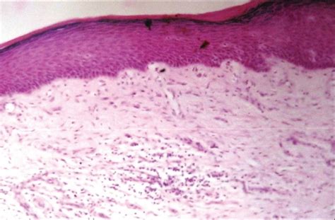 Photomicrograph Showing Hyperorthokeratosis And Atrophic Stratified