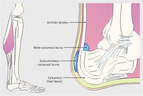 Pain At The Back Of The Heel The Bmj