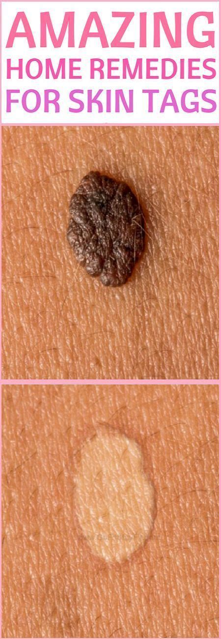 get rid of skin tags with this home remedies skin tags home remedies