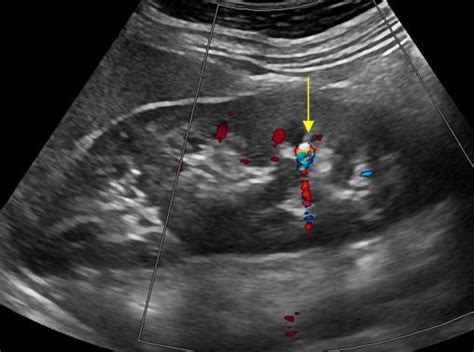 Gynaecology 3 2 Adnexa Case 3 2 2 Dermoid Cysts