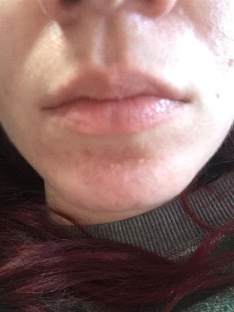 Small Skin Colored Bumps On Chin Acne