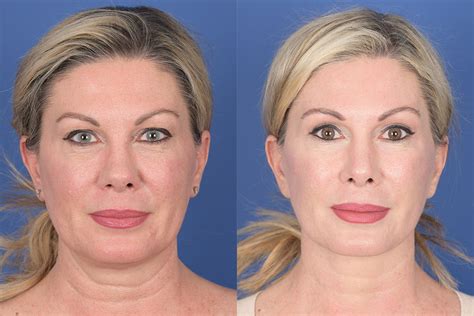 Necklift Before And After 21 Weber Facial Plastic Surgery
