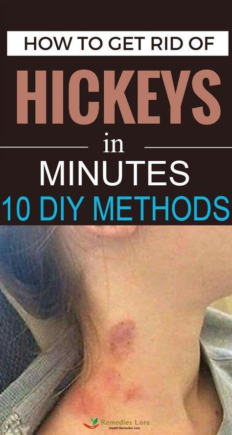 how to remove or hide a hickey love bite fast in 2020 with images