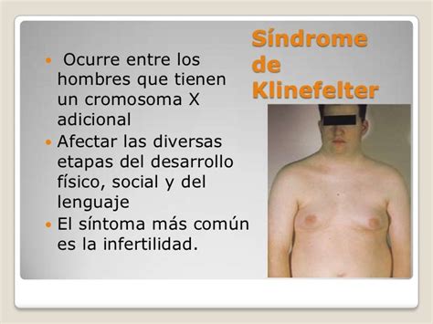 Sindrome De Klinefelter