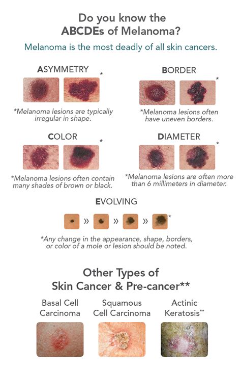 5 Warning Signs Of Skin Cancer