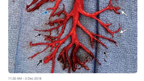 nejm shares odd photo  blood clot shaped  lung  man spit