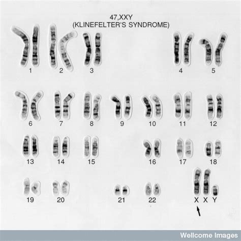 file 47 xxy klinefelter s syndrome embryology