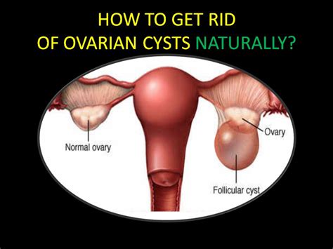 how to get rid of ovarian cysts naturally youtube