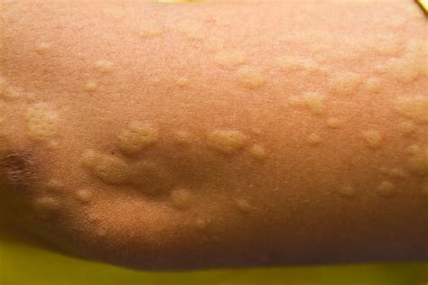 what are the common causes of hives