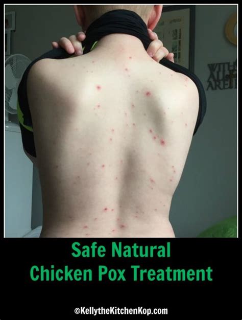 Safe Natural Chicken Pox Treatment Yep We Had Chicken Pox Here